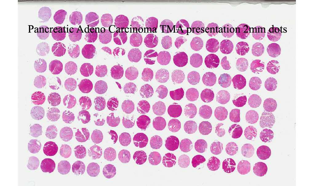 Pancreatic Adeno Carcinoma TMA presentation 2mm dots